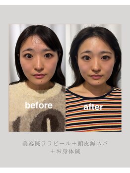 マホロバ(mahoroba)/美容鍼+ララピール
