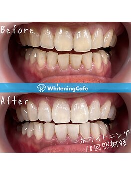 ホワイトニングカフェ 上田店/ホワイトニングビフォーアフター