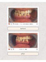 スマイルプライベートビューティサロン(Smile)/セルフホワイトニング（初回）