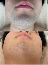 モット いこらもーる泉佐野店(mot)/メンズお顔脱毛