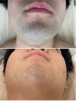 モット いこらもーる泉佐野店(mot)/メンズお顔脱毛