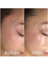 ユカリス(Yu.charis)/ワックス脱毛 before→after