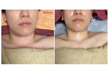 ミュー 新小岩店(Mieux)/ハイパーナイフEX小顔矯正70分