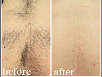 エリクサー 加須店(Elixir)/胸毛!撲滅!