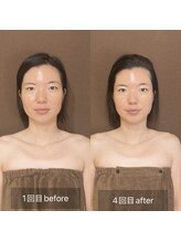 ラペ(La paix)/脳洗浄before/after