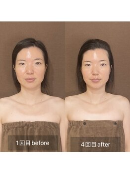 ラペ(La paix)/脳洗浄before/after
