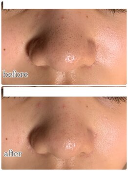 アロマ&クレイケアルーム ネロリドール(Nerolidol)/角栓除去にも