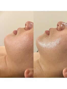 グラン ジュテ/レモンボトル注入