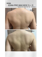 UBメディカルサロン 新宿/インディバ　背中上部