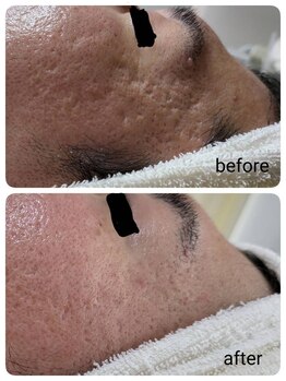 レゾン 京橋店/【Before/after】ニキビケア