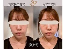 チョコバリ 新宿店(chocobari)/小顔×リフトアップ(美容鍼)30代