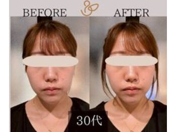 チョコバリ 新宿店(chocobari)/小顔×リフトアップ(美容鍼)30代