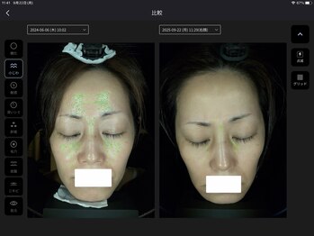 プレジール(Plaisir)/AI肌診断ビフォーアフター小じわ