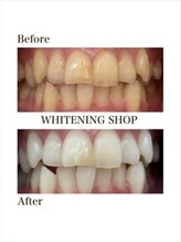 ホワイトニングショップ 福岡香椎店/美容ホワイトニング