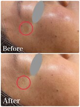 ルタンリッシュ ハナレ(Lutan Riche 花麗)/長年悩んでいたシミが薄く！！