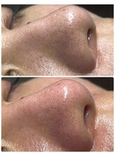 ポマイカイ 名古屋丸の内店(pomaikai)/ハイドロフェイシャル