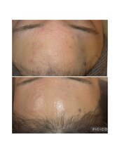 ビエン(美艶 b.en)/おでこもつるんと！