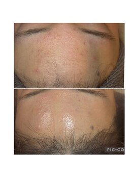 ビエン(美艶 b.en)/おでこもつるんと！