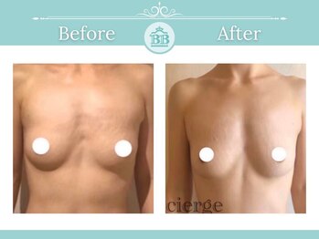 美人バスト 浜松店/◇ バストアップ &nbsp;BeforeAfter◇