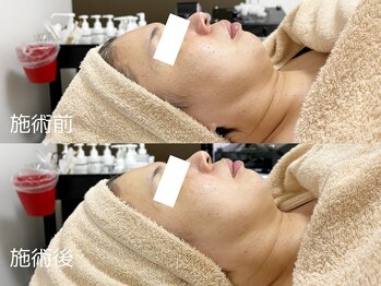 キーオブフェイス(Key of Face)/お悩み【たるみ+首のシワ】