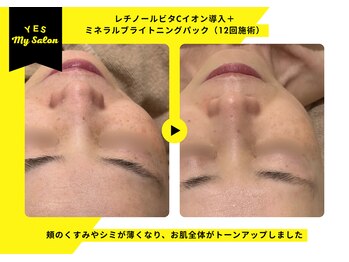 イエス マイサロン(yes My Salon)/ENVIRONトリートメント症例