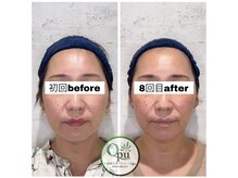 キュープ 相模原淵野辺店(Qpu)/たった4回で人生で1番小さな顔に