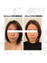 ザビューティー 麻布十番本店(The Beauty)/12Dリフト全顔打ち放題[リフト]