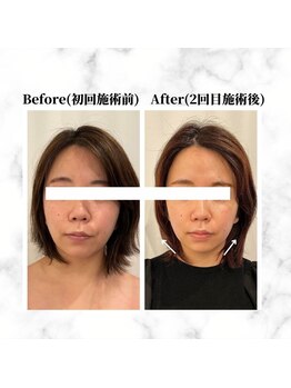 ザビューティー 麻布十番本店(The Beauty)/12Dリフト全顔打ち放題[リフト]