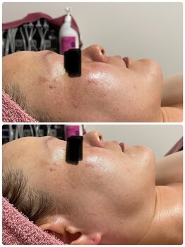 アンヘル(Angel)/揺らぎ肌にはマーメイドセル