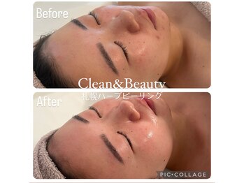 クリーンアンドビューティ 札幌(Clean&Beauty)/適切なホームケアもプラスして♪