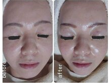 レゾン 京橋店/【Before/after】エイジングケア