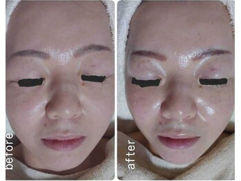 レゾン 京橋店/【Before/after】エイジングケア