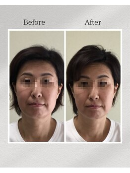 トータルトリートメント優鍼灸院/美容鍼　1回施術の効果