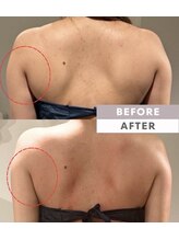 フレイヤビューティー スハダラボ 恵比寿(Freyia Beauty Suhada LABO)/-脂肪分解-