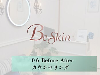 ビースキン 広島(BE:SKIN)/6.Before→After/カウンセリング