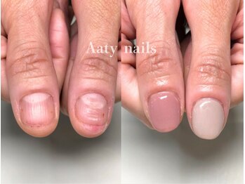 【深爪矯正】ハンド