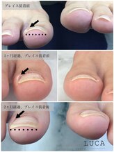 ネイルアトリエルカ(nail atelier LUCA)/W-608 夏前までに巻いた爪改善