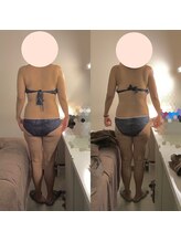 アクア エステティコ 亀有(ACQUA estetico)/中半身痩身　6回