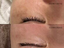 レイル(REIR)/メニュー：純粋レチノールピール