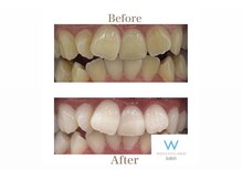 ホワイトニングショップ 島根店/Before&After美白ホワイトニング
