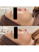 ツール(TOOL)/ハーブピーリング