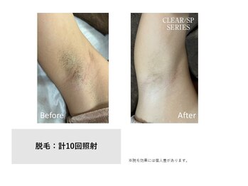 スタンド(STAND)/わき脱毛 before after