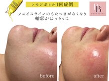 レモンボトル×フォト★輪郭ハッキリ！ハリ艶肌が叶う！即効小顔