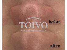 トイヴォ(TOIVO)/毛穴洗浄ビフォーアフター！