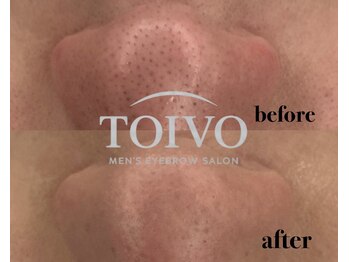 トイヴォ(TOIVO)/毛穴洗浄ビフォーアフター!