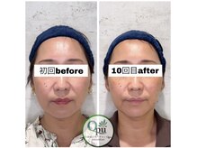 キュープ 相模原淵野辺店(Qpu)/たった4回で人生で1番小さな顔に