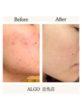 アルゴ 志免店(ALGO)/スキンケアで土台から変える！