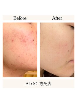 アルゴ 志免店(ALGO)/スキンケアで土台から変える！