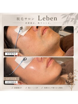 レーベン 戸畑店(Leben)/ヒゲ脱毛の変化