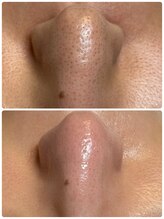 ラナ(Lana)/毛穴エクストラクション